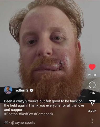 Red Sox star Justin Turner leaves game after hit to face